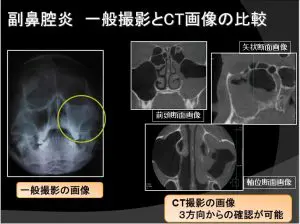 耳鼻咽喉の臨床X線診断学 健康・医学